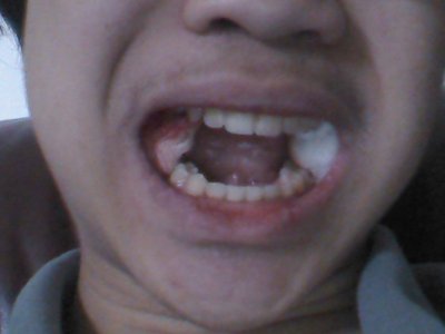 wisdom_teeth_extracted.jpg